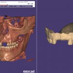02-Match-DICOM-Data-with-optical-scan-data-150×150