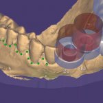 12-Create-the-top-of-the-surgical-guide-150×150