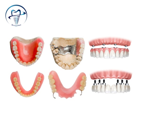 انواع پروتزهای دندان