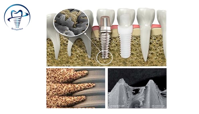 تصاوير شبیه سازی شده و واقعی از طرز استخوان سازی شکل گرفته حول ايمپلنت دندان در درون فک