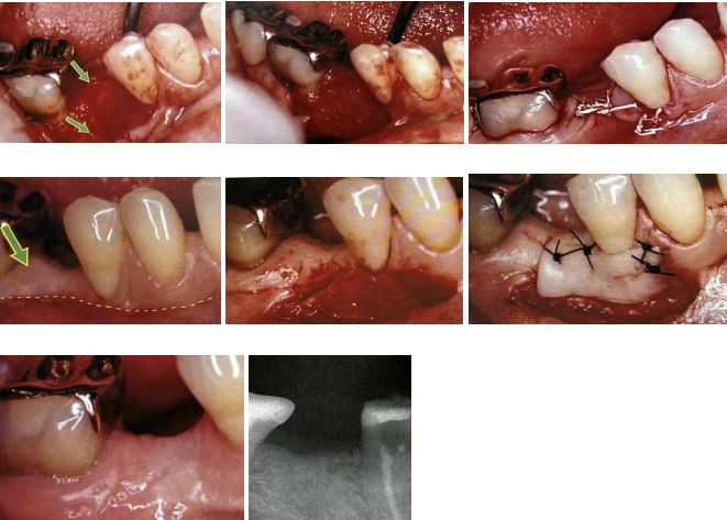 برنامه ریزی درمانی در ایمپلنتولوژی دندان بافت کراتینه شده لثه 2