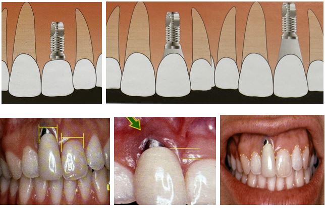 برنامه ریزی درمانی در ایمپلنتولوژی دندان ارزیابی بوکو زبانی 2