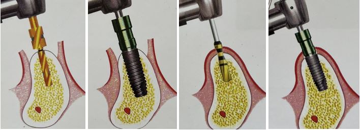 <img src=”Flapless Implant Surgeries.png” alt=”جراحی ایمپلنت بدون فلپ”>