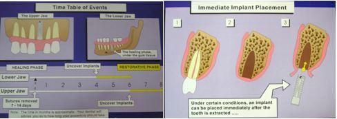 سیستم های کاشت ایمپلنت های دندانی