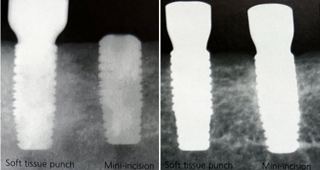 ایمپلنتولوژی بدون فلپ : مقایسه تحلیل استخوان اطراف ایمپلنت