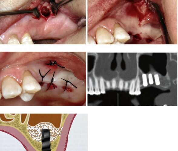 ایمپلنتولوژی بدون فلپ برنامه ریزی درمانی برای بی دندان خلفی فک بالا قسمت دوم
