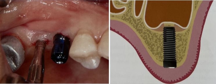 ایمپلنتولوژی بدون فلپ برنامه ریزی درمانی برای بی دندان خلفی ماگزیلا