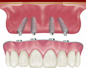 <img src=”Evaluation of the anterior maxillary region before implant placement.png” alt=”ارزیابی ناحیه قدامی فک بالا قبل از کاشت ایمپلنت”>